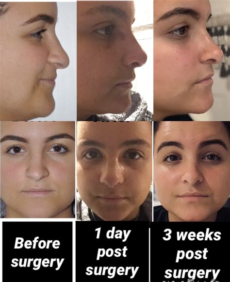 If the impact is severe, the nasal. . 3 weeks after rhinoplasty